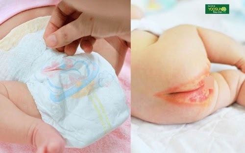 Chủ đề: Bất ngờ trước công thức phòng ngừa và chữa trị hăm da được hàng triệu mẹ bỉm sữa truyền tai nhau!