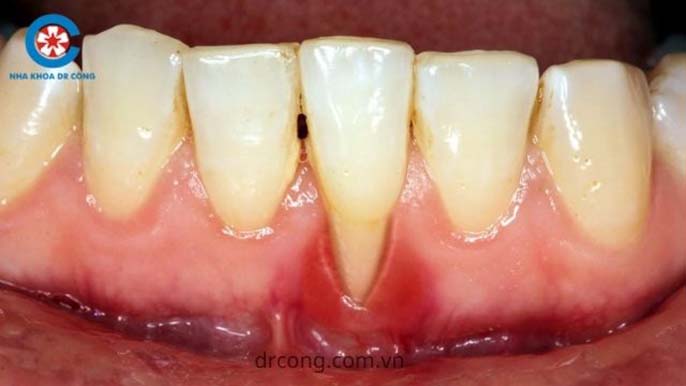 Nha khoa Dr Công - Địa Chỉ Chữa Tụt Lợi Nướu An Toàn Thẩm Mỹ